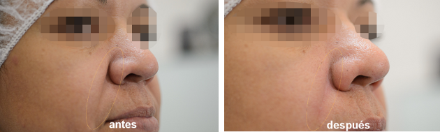 Bioplastía - Relleno de arrugas, antes y después
